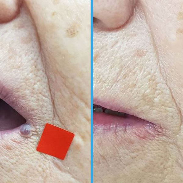 Before and after — A fibroma next to the lip
